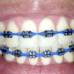 Where Can You Find Quality Power Chain Braces?