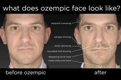 Where Can You Find Plastic Surgeons Ozempic Face?