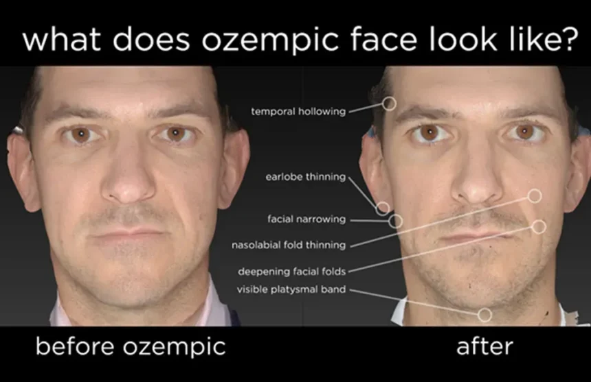 Where Can You Find Plastic Surgeons Ozempic Face?