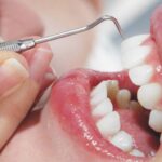 What Are the Best Services Teeth Cleaning Near Me?