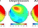 Exploring the Benefits of qeeg brain mapping