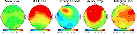 Exploring the Benefits of qeeg brain mapping