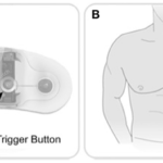 zio patch :Loop Monitor, Woodholme Cardiovascular Associates