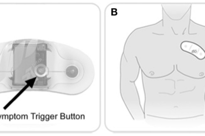 zio patch :Loop Monitor, Woodholme Cardiovascular Associates