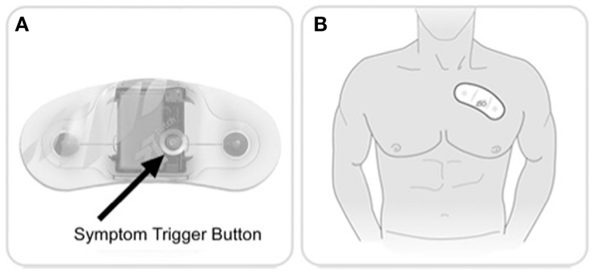 zio patch :Loop Monitor, Woodholme Cardiovascular Associates