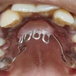 Thumb Sucking Habit Breaker