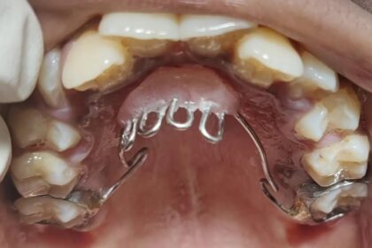 Thumb Sucking Habit Breaker