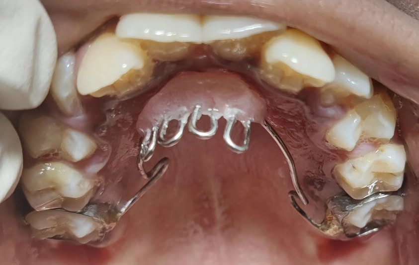 Thumb Sucking Habit Breaker