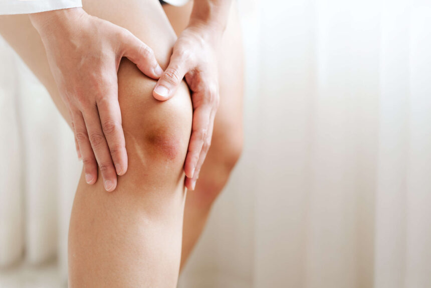  Qué Es Bueno Para Los Golpes? Tips and Remedies to Relieve Pain and Inflammation