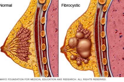 Fibrocystic Breast Disease Specialist: Understanding the Role and Importance of Expert Care