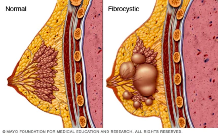 Fibrocystic Breast Disease Specialist: Understanding the Role and Importance of Expert Care