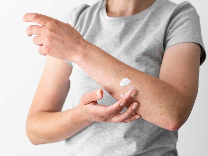 Hongos En La Piel Manchas: A Complete Guide to Understanding, Preventing, and Treating This Condition