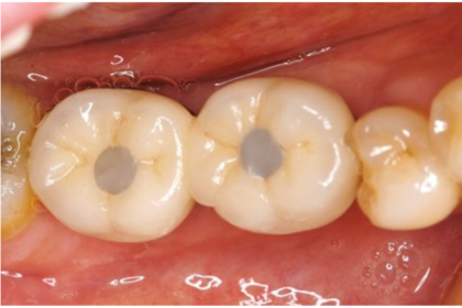 Teeth Hole Repair: A Comprehensive Guide to Restoring Dental Health and Confidence