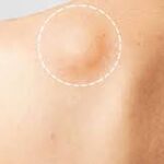 Lipoma De Grasa: Everything You Need to Know