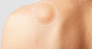 Lipoma De Grasa: Everything You Need to Know