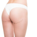 Implantes de Nalgas: Todo lo que Necesitas Saber sobre la Cirugía de Aumento de Glúteos