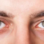 The Konjuktivitis: An In-Depth Exploration of Conjunctivitis