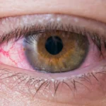 La Nube en el Ojo: Explorando la Metáfora y la Realidad